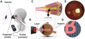 A Camera
Projection module
Pocket processor
B Laser
C
D Implant
E